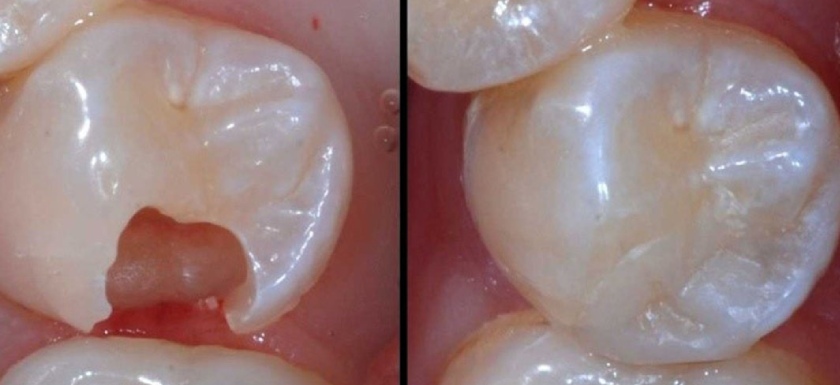 Trám răng hàm bị vỡ